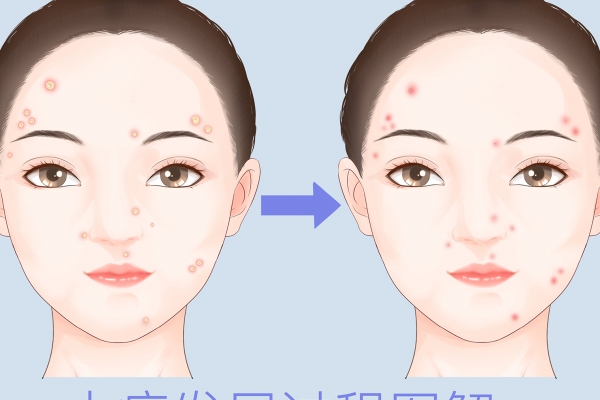 水痘的传播途径