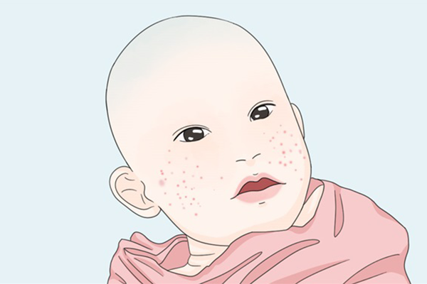新生儿湿疹怎么处理