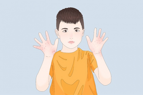湿疹快速止痒的方法