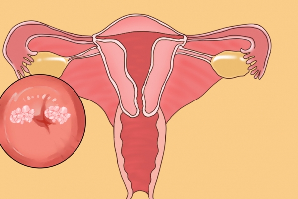 尖锐湿疣的症状有哪些