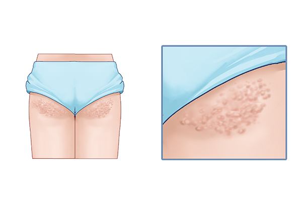 湿疹是什么原因引起的呢