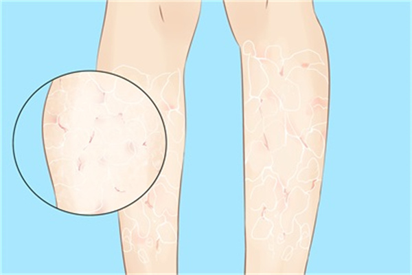 湿疹太痒了怎么办