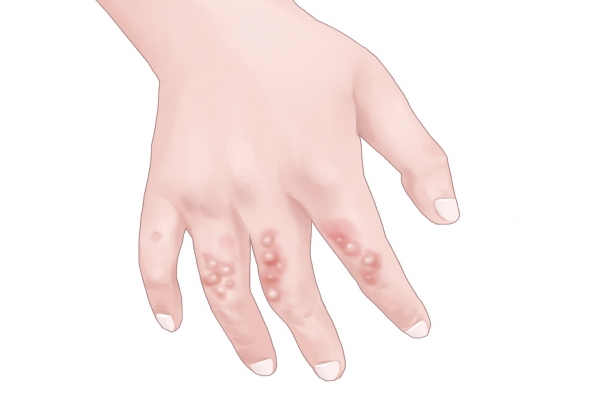 湿疹不能吃什么食物