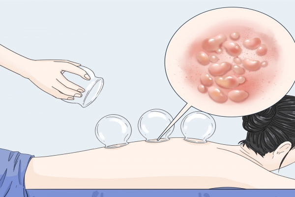 拔罐起水泡是湿气重吗