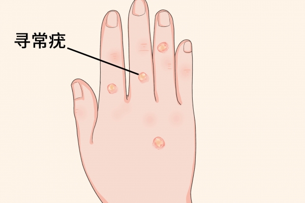 感染HPV有什么症状