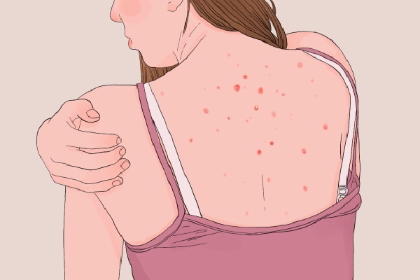 身体湿气重的6个表现有哪些