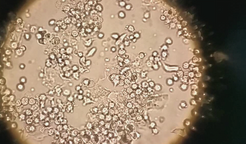 滴虫严重还是念珠菌严重2