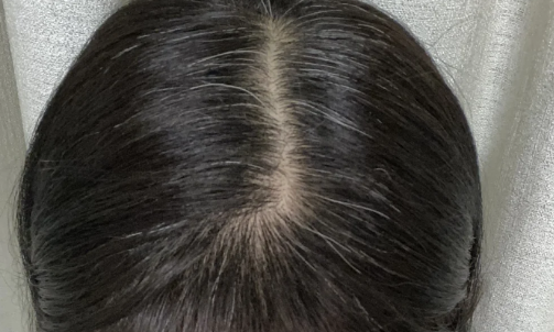 白头发看中医挂什么科2