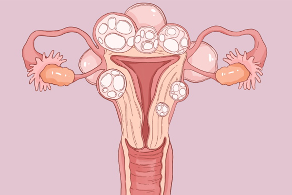 子宫肌瘤能吃桂圆吗