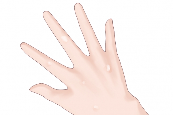 传染性软疣是性传播吗