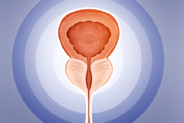 白头翁汤治前列腺增生吗