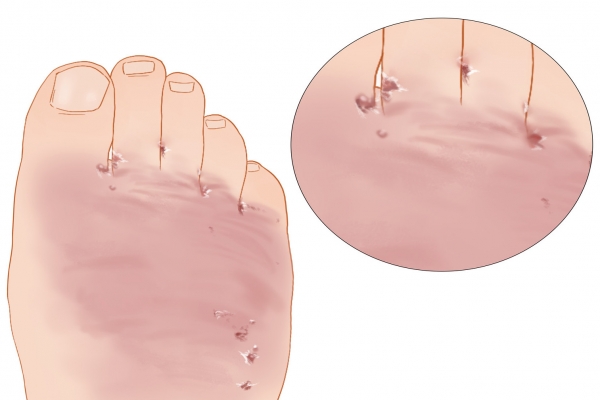 白头翁可以治疗脚气吗