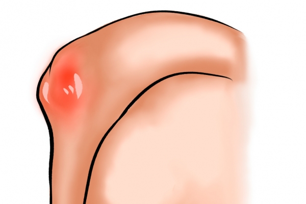 白头翁可以治疗痛风吗
