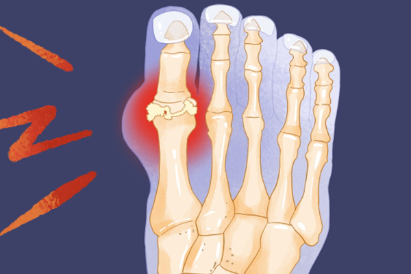 白头翁可以治疗痛风吗