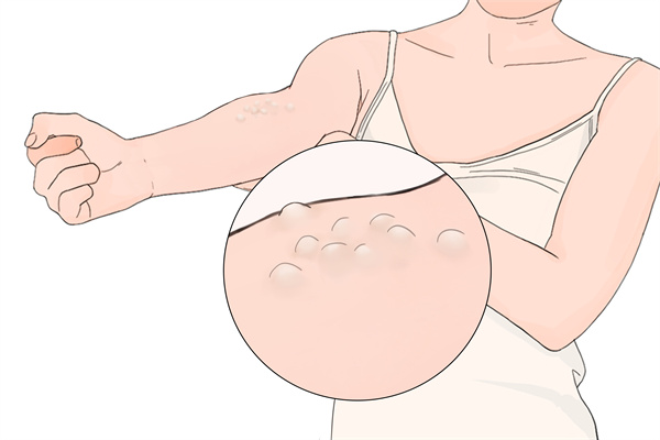 白头翁药材治疗囊肿吗