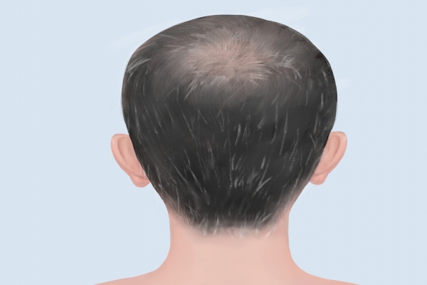 白头翁汤能治疗白发吗