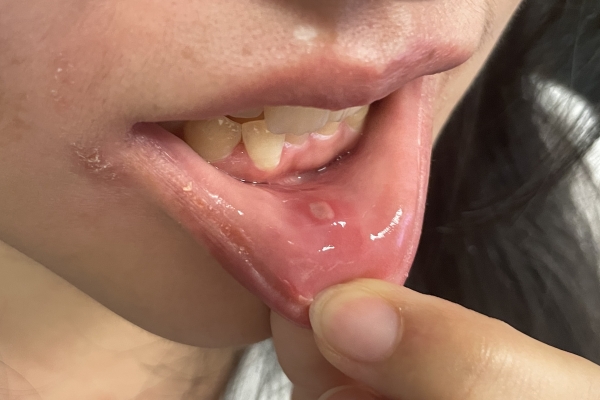 白头翁治疗烂嘴有效吗