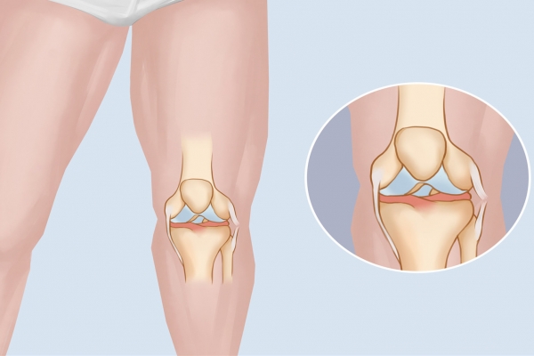 肌肉拉伤的症状表现有哪些