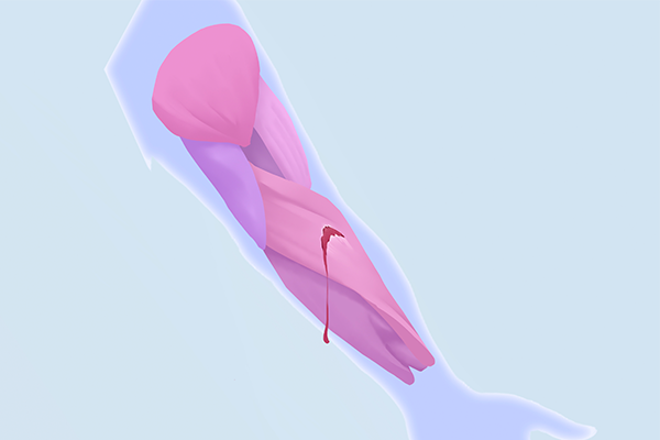 肌肉拉伤的症状表现有哪些