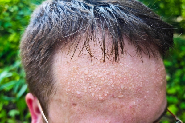 盗汗和自汗有什么区别