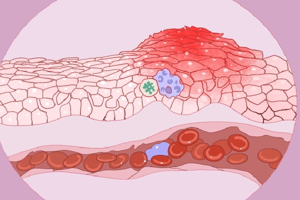 前白蛋白400偏高怎么办