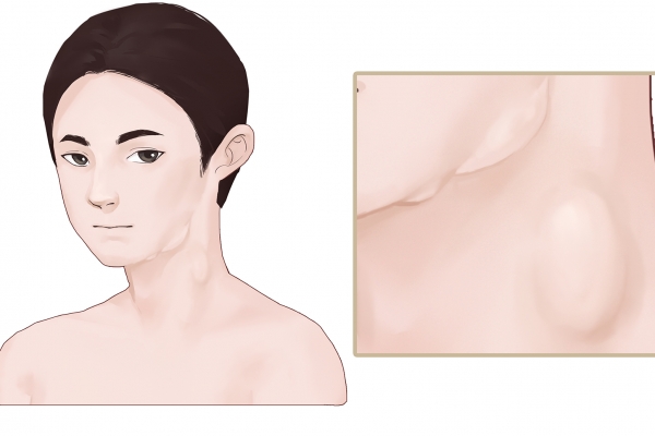 淋巴结发炎的症状和治疗