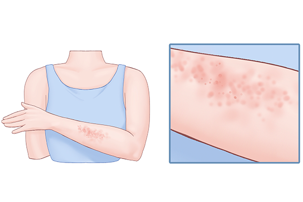 银杏吃多了会有哪些副作用